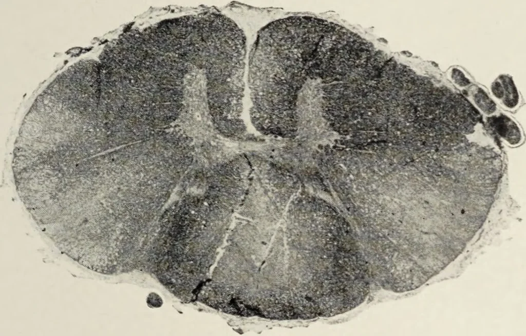 An illustration from A text-book of pathology / by Alfred Stengel ; with 394 illustrations in the text, many of them in colors, and 7 full-page chromolithographic plates., 1903, leaf 885