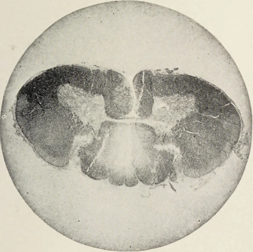 An illustration from A text-book of pathology / by Alfred Stengel ; with 394 illustrations in the text, many of them in colors, and 7 full-page chromolithographic plates., 1903, leaf 885