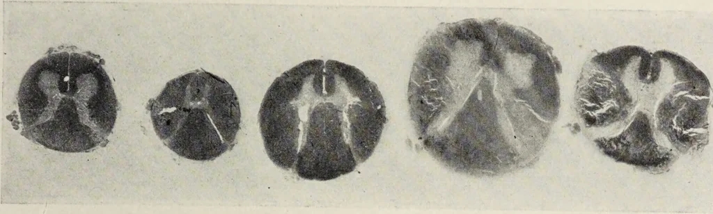 An illustration from A text-book of pathology / by Alfred Stengel ; with 394 illustrations in the text, many of them in colors, and 7 full-page chromolithographic plates., 1903, leaf 889