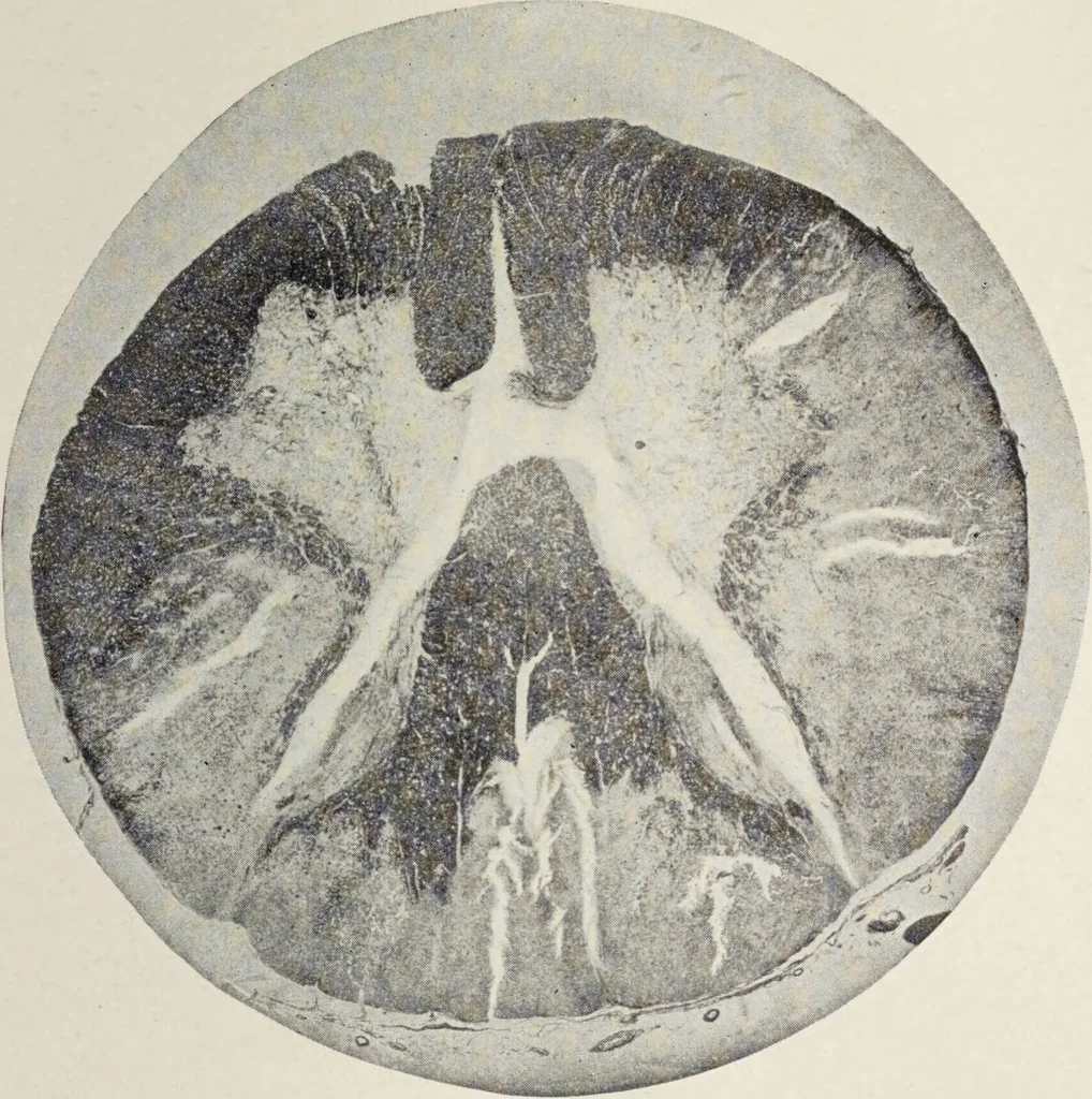 An illustration from A text-book of pathology / by Alfred Stengel ; with 394 illustrations in the text, many of them in colors, and 7 full-page chromolithographic plates., 1903, leaf 889