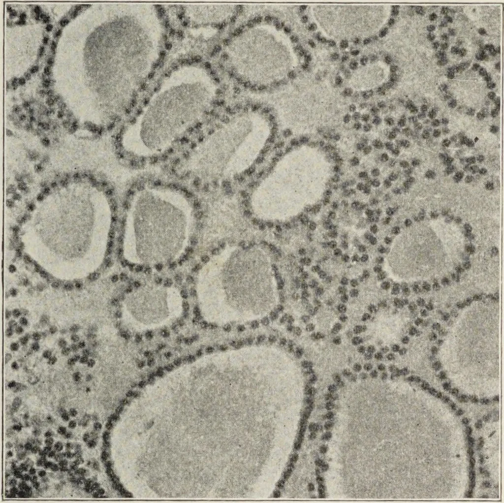 An illustration from A text-book of pathology / by Alfred Stengel ; with 394 illustrations in the text, many of them in colors, and 7 full-page chromolithographic plates., 1903, leaf 89