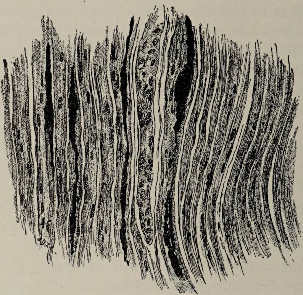 An illustration from A text-book of pathology / by Alfred Stengel ; with 394 illustrations in the text, many of them in colors, and 7 full-page chromolithographic plates., 1903, leaf 896