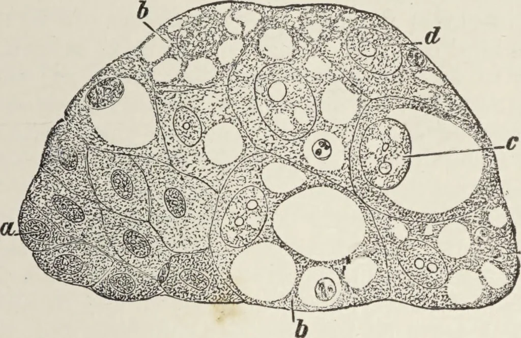 An illustration from A text-book of pathology / by Alfred Stengel ; with 394 illustrations in the text, many of them in colors, and 7 full-page chromolithographic plates., 1903, leaf 91