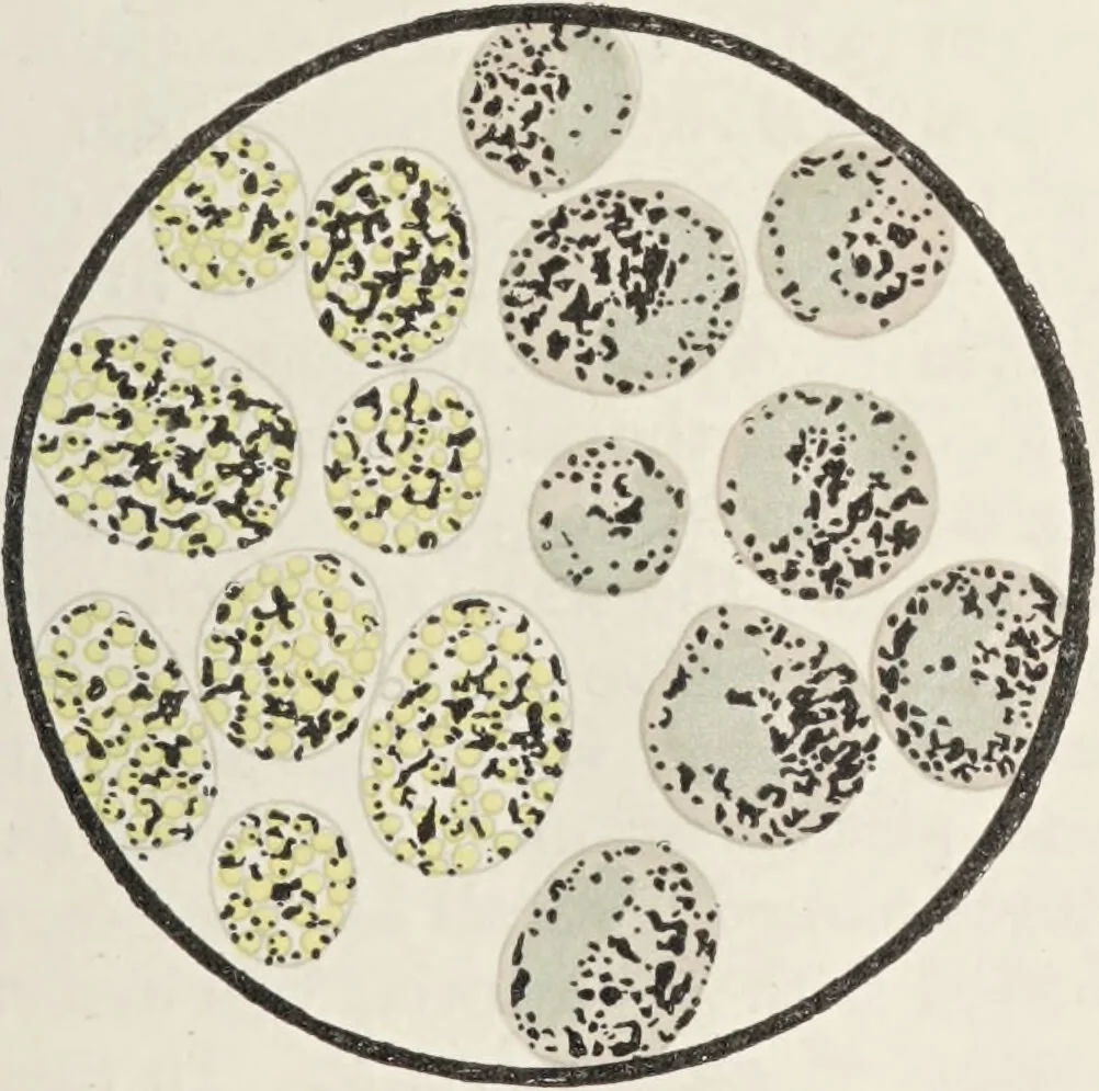 An illustration from A text-book of pathology / by Alfred Stengel ; with 394 illustrations in the text, many of them in colors, and 7 full-page chromolithographic plates., 1903, leaf 95