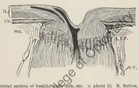 Picture 4 of 13 from Diseases of the eye (1900), leaf 78