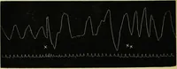 Picture 6 of 7 from Psycho-therapeutics : or, treatment by hypnotism and suggestion (1891), leaf 241