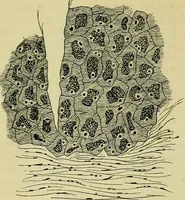 An illustration from Pestilentia in nummis. Geschichte der grossen Volkskrankheiten in numismatischen Documenten. Ein Beitrag zur Geschichte der Medicin und der Cultur (1882)
