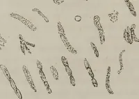 An illustration from Illustrations of disease with the microscope. clinical investigations, aided by the microscope, and by chemical reagents, with microscopical observations of pathological specimens, medical and surgical, obtained in Charleston, S.C. : a contribution intended to disclose the minute history of the diseases prevailing in this latitude, and to assist future students (1861)