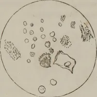 An illustration from Illustrations of disease with the microscope. clinical investigations, aided by the microscope, and by chemical reagents, with microscopical observations of pathological specimens, medical and surgical, obtained in Charleston, S.C. : a contribution intended to disclose the minute history of the diseases prevailing in this latitude, and to assist future students (1861)