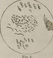 An illustration from Illustrations of disease with the microscope. clinical investigations, aided by the microscope, and by chemical reagents, with microscopical observations of pathological specimens, medical and surgical, obtained in Charleston, S.C. : a contribution intended to disclose the minute history of the diseases prevailing in this latitude, and to assist future students (1861)