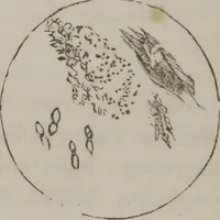 An illustration from Illustrations of disease with the microscope. clinical investigations, aided by the microscope, and by chemical reagents, with microscopical observations of pathological specimens, medical and surgical, obtained in Charleston, S.C. : a contribution intended to disclose the minute history of the diseases prevailing in this latitude, and to assist future students (1861)