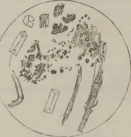 An illustration from Illustrations of disease with the microscope. clinical investigations, aided by the microscope, and by chemical reagents, with microscopical observations of pathological specimens, medical and surgical, obtained in Charleston, S.C. : a contribution intended to disclose the minute history of the diseases prevailing in this latitude, and to assist future students (1861)