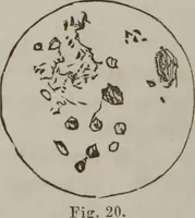 An illustration from Illustrations of disease with the microscope. clinical investigations, aided by the microscope, and by chemical reagents, with microscopical observations of pathological specimens, medical and surgical, obtained in Charleston, S.C. : a contribution intended to disclose the minute history of the diseases prevailing in this latitude, and to assist future students (1861)