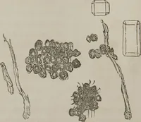 An illustration from Illustrations of disease with the microscope. clinical investigations, aided by the microscope, and by chemical reagents, with microscopical observations of pathological specimens, medical and surgical, obtained in Charleston, S.C. : a contribution intended to disclose the minute history of the diseases prevailing in this latitude, and to assist future students (1861)