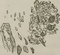 An illustration from Illustrations of disease with the microscope. clinical investigations, aided by the microscope, and by chemical reagents, with microscopical observations of pathological specimens, medical and surgical, obtained in Charleston, S.C. : a contribution intended to disclose the minute history of the diseases prevailing in this latitude, and to assist future students (1861)