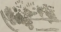 An illustration from Illustrations of disease with the microscope. clinical investigations, aided by the microscope, and by chemical reagents, with microscopical observations of pathological specimens, medical and surgical, obtained in Charleston, S.C. : a contribution intended to disclose the minute history of the diseases prevailing in this latitude, and to assist future students (1861)