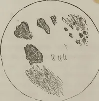 An illustration from Illustrations of disease with the microscope. clinical investigations, aided by the microscope, and by chemical reagents, with microscopical observations of pathological specimens, medical and surgical, obtained in Charleston, S.C. : a contribution intended to disclose the minute history of the diseases prevailing in this latitude, and to assist future students (1861)