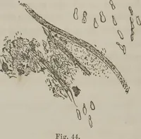An illustration from Illustrations of disease with the microscope. clinical investigations, aided by the microscope, and by chemical reagents, with microscopical observations of pathological specimens, medical and surgical, obtained in Charleston, S.C. : a contribution intended to disclose the minute history of the diseases prevailing in this latitude, and to assist future students (1861)