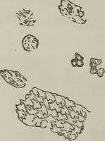 An illustration from Illustrations of disease with the microscope. clinical investigations, aided by the microscope, and by chemical reagents, with microscopical observations of pathological specimens, medical and surgical, obtained in Charleston, S.C. : a contribution intended to disclose the minute history of the diseases prevailing in this latitude, and to assist future students (1861)