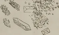 An illustration from Illustrations of disease with the microscope. clinical investigations, aided by the microscope, and by chemical reagents, with microscopical observations of pathological specimens, medical and surgical, obtained in Charleston, S.C. : a contribution intended to disclose the minute history of the diseases prevailing in this latitude, and to assist future students (1861)