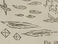 Picture 39 of 58 from Illustrations of disease with the microscope. clinical investigations, aided by the microscope, and by chemical reagents, with microscopical observations of pathological specimens, medical and surgical, obtained in Charleston, S.C. : a contribution intended to disclose the minute history of the diseases prevailing in this latitude, and to assist future students (1861), leaf 123