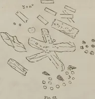 Picture 42 of 58 from Illustrations of disease with the microscope. clinical investigations, aided by the microscope, and by chemical reagents, with microscopical observations of pathological specimens, medical and surgical, obtained in Charleston, S.C. : a contribution intended to disclose the minute history of the diseases prevailing in this latitude, and to assist future students (1861), leaf 125