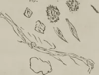 An illustration from Illustrations of disease with the microscope. clinical investigations, aided by the microscope, and by chemical reagents, with microscopical observations of pathological specimens, medical and surgical, obtained in Charleston, S.C. : a contribution intended to disclose the minute history of the diseases prevailing in this latitude, and to assist future students (1861)