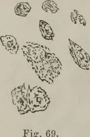 An illustration from Illustrations of disease with the microscope. clinical investigations, aided by the microscope, and by chemical reagents, with microscopical observations of pathological specimens, medical and surgical, obtained in Charleston, S.C. : a contribution intended to disclose the minute history of the diseases prevailing in this latitude, and to assist future students (1861)