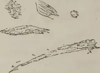 An illustration from Illustrations of disease with the microscope. clinical investigations, aided by the microscope, and by chemical reagents, with microscopical observations of pathological specimens, medical and surgical, obtained in Charleston, S.C. : a contribution intended to disclose the minute history of the diseases prevailing in this latitude, and to assist future students (1861)