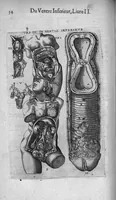 An illustration from Les Oeuvres de chirurgie de Jacques Guillemeau, chirurgien ordinaire du Roy et Juré à paris, divisées en treize livres. Avec les Portraicts & Figures Anatomiques de toutes les parties du corps humain. Et des Instrumens necessaires au Chirurgien. Derniere edition (1602)