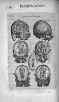 Picture 7 of 27 from Les Oeuvres de chirurgie de Jacques Guillemeau, chirurgien ordinaire du Roy et Juré à paris, divisées en treize livres. Avec les Portraicts & Figures Anatomiques de toutes les parties du corps humain. Et des Instrumens necessaires au Chirurgien. Derniere edition (1602), leaf 87