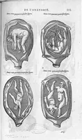 An illustration from Les Oeuvres d’Ambroise Paré, conseiller et premier chirurgien du roy, divisées en vingt-sept livres : avec les figures et portraicts tant de l’Anatomie que des instruments de chirurgie et de plusieurs monstres : reveuz et augmentez par l’autheur pour la seconde Edition, Paris, (1579)