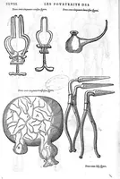 An illustration from Les Oeuvres d’Ambroise Paré, conseiller et premier chirurgien du roy, divisées en vingt-sept livres : avec les figures et portraicts tant de l’Anatomie que des instruments de chirurgie et de plusieurs monstres : reveuz et augmentez par l’autheur pour la seconde Edition, Paris, (1579)