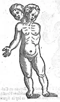 An illustration from Les Oeuvres d’Ambroise Paré, conseiller et premier chirurgien du roy, divisées en vingt-sept livres : avec les figures et portraicts tant de l’Anatomie que des instruments de chirurgie et de plusieurs monstres : reveuz et augmentez par l’autheur pour la seconde Edition, Paris, (1579)