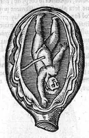 An illustration from Oeuvres de chirurgie (1649)