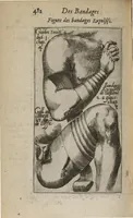 Picture 3 of 3 from Oeuvres du sieur Jacq. De Marque...contenant sa Methodique Introduction à la Chirurgie, divisée en deux parties...Ensemble son Traité des Bandages...me tout représenté par figures gravées en cuivre (1662), leaf 507