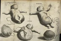 An illustration from Discours anatomiques sur le sujet d'un enfant d'une figure extraordinaire (1671)