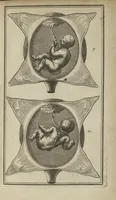 An illustration from La pratique des accouchemens, [suivi par] réponse à l'avertissement, réponse de Mr Peu aux observations particulières de Mr Mauriceau sur la grossesse et l'acouchement des femmes (1694)