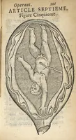 An illustration from L'accoucheur methodique, qui enseigne la maniere d'operer dans tous les accouchements naturels et artificiels... (1676)