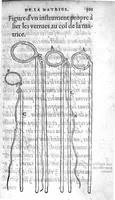 Picture 11 of 31 from Deux livres de chirurgie, I. De la generation de l’homme, et maniere d’extraire les enfans hors du ventre de la mere, ensemble ce qu’il faut faire pour la faire mieux, et plus tost accoucher, avec la cure de plusieurs maladies qui luy peuvent survenir. 2. Des monstres tant terrestres que marins, avec leurs portrait. Plus un petit traité des plaies faites aux parties nerveuses. Par Ambroise Paré, premier Chirurgien du Roy, et juré à Paris, (1573), leaf 320