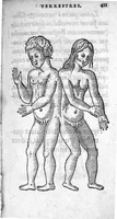 An illustration from Deux livres de chirurgie, I. De la generation de l’homme, et maniere d’extraire les enfans hors du ventre de la mere, ensemble ce qu’il faut faire pour la faire mieux, et plus tost accoucher, avec la cure de plusieurs maladies qui luy peuvent survenir. 2. Des monstres tant terrestres que marins, avec leurs portrait. Plus un petit traité des plaies faites aux parties nerveuses. Par Ambroise Paré, premier Chirurgien du Roy, et juré à Paris, (1573)