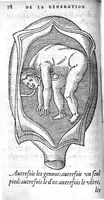 An illustration from Deux livres de chirurgie, I. De la generation de l’homme, et maniere d’extraire les enfans hors du ventre de la mere, ensemble ce qu’il faut faire pour la faire mieux, et plus tost accoucher, avec la cure de plusieurs maladies qui luy peuvent survenir. 2. Des monstres tant terrestres que marins, avec leurs portrait. Plus un petit traité des plaies faites aux parties nerveuses. Par Ambroise Paré, premier Chirurgien du Roy, et juré à Paris, (1573)