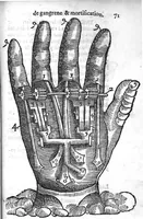 An illustration from La maniere de traicter les playes faictes tant par hacquebutes, que par fleches : et les accidentz d’icelles, comme fractures et caries des os, gangrene et mortification : avec les pourtraictz des instrumentz necessaires pour leur curation. Et la methode de curer les combustions principalement faictes par la pouldre à canon. Le tout composé par Ambroise Paré, maistre Barbier Chirurgien à Paris (1552)