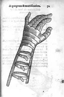 Picture 26 of 27 from La maniere de traicter les playes faictes tant par hacquebutes, que par fleches : et les accidentz d’icelles, comme fractures et caries des os, gangrene et mortification : avec les pourtraictz des instrumentz necessaires pour leur curation. Et la methode de curer les combustions principalement faictes par la pouldre à canon. Le tout composé par Ambroise Paré, maistre Barbier Chirurgien à Paris (1552), leaf 158