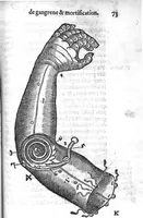 Picture 27 of 27 from La maniere de traicter les playes faictes tant par hacquebutes, que par fleches : et les accidentz d’icelles, comme fractures et caries des os, gangrene et mortification : avec les pourtraictz des instrumentz necessaires pour leur curation. Et la methode de curer les combustions principalement faictes par la pouldre à canon. Le tout composé par Ambroise Paré, maistre Barbier Chirurgien à Paris (1552), leaf 160
