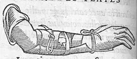 Picture 7 of 11 from La Méthode de traicter les playes faictes par hacquebutes et aultres bastons à feu et de celles qui sont faictes par flèches, dardz et semblables, aussy des combustions spécialement faictes par la pouldre à canon, composée par Ambroyse Paré,... (1545), leaf 76