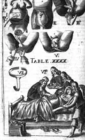 An illustration from L'arcenal de chirurgie (1675)