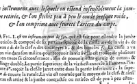 An illustration from L'arcenal de chirurgie (1675)
