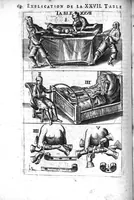 An illustration from L'arcenal de chirurgie (1675)