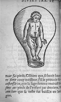 An illustration from Des divers travaulx et enfantemens des femmes. Et par quel moyen lon doibt survenir aux accidens qui peuvent eschoir devant et apres iceux travaulx, devisé en deux petiz livres. Premierement composez en Latin, par maistre Euchaire Rodion, Docteur en Medecine, et depuis tournez en nostre langue Françoyse, et augmentez de Annotations, par M. Paul Bienassis de Poictiers, à l’utilité de plusieurs personnes. Avec Indice des choses memorables contenues en ce present livre, mises par chapitres en la fin d’icelluy (1563)